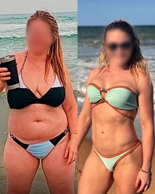 Veja essa transformação - Lipoaspiração de definição associada a argoplasma + mastopexia com prótese