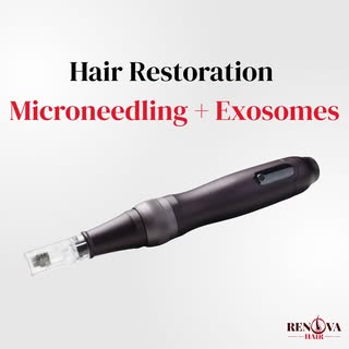 🧬 MICRONEEDLING + EXOSOMES FOR HAIR LOSS: WHAT’S THE DEAL?

One of the most advanced non-surgical h