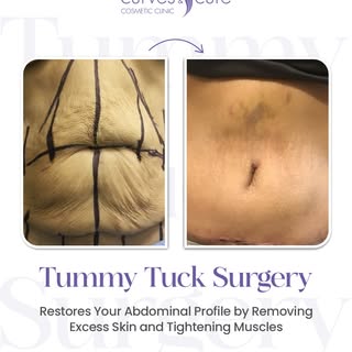 When diet and exercise aren't enough, Tummy Tuck restores your abdominal profile by removing excess 