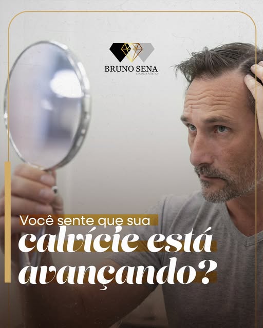 A calvície costuma surgir de forma gradual, geralmente com o afinamento dos fios na região frontal e
