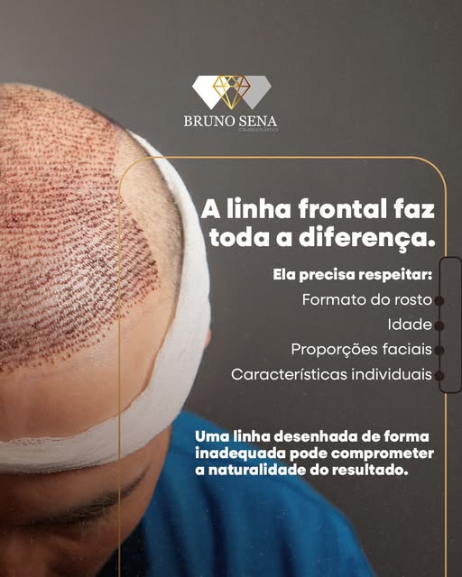 Um transplante capilar de qualidade vai muito além da quantidade de fios transplantados. O que faz a