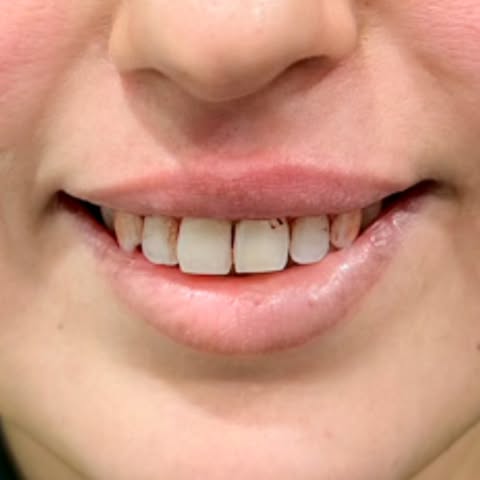 Tired of temporary fixes? 
Get a surgical and permanent Gummy Smile Treatment at Cosmetic Enclave.