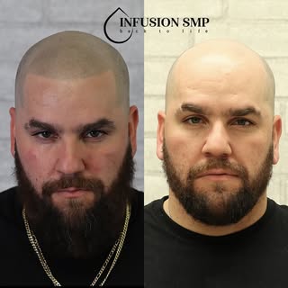 Natural Hairline Design
The photographs in this post are a more natural style SMP. Each client has h