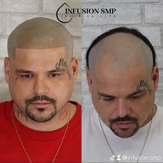 Shape UP SMP Style
The photographs provided in this post are a more bold look for SMP. These procedu