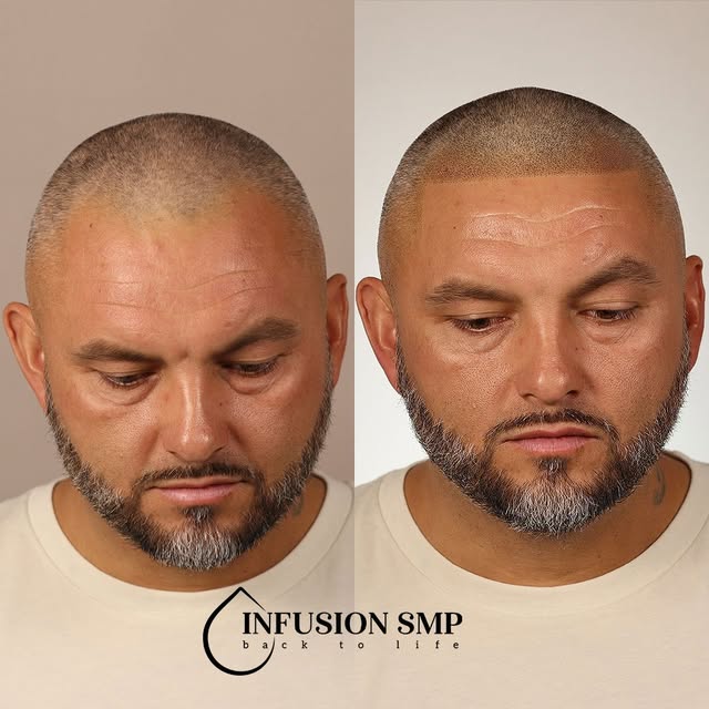 FIRST SESSION RESULTS 🔥

This client originally came in for a consultation with plenty of hair, but