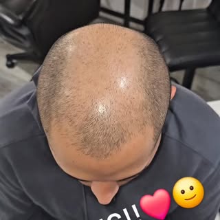 What a transformation 👏 😍 🙌 

#smp #scalpmicropigmentation #hairloss #alopecia #losangeleshair