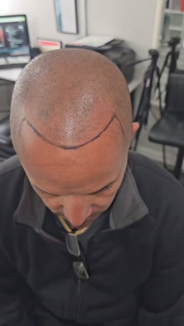 THE ART OF NATURAL SMP🔥🔥💯
NEW HAIR LINE
COMPLETE NATURAL LOOK 👀💯 
.
.
"Absolutely worth it" 👍
