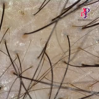 LA MINIATURIZZAZIONE

L’alopecia androgenetica è una patologia cronico-evolutiva caratterizzata da