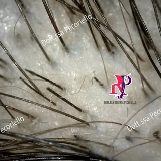 PILLOLE DI TRICOLOGIA
#tricotillomania #tricoscopia #disturbiossessivocompulsivi #tricologia #stress
