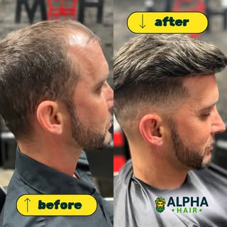 Say goodbye to thinning hair and hello to confidence! Witness the incredible transformation as our c