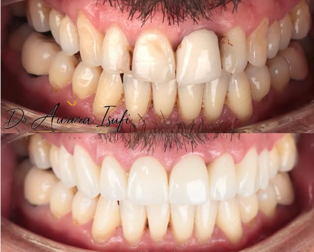 Transformim estetik i buzëqeshjes me fokus në harmoninë dentare, proporcione të balancuara dhe një r