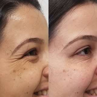 Rugas de expressão!!! Incomodado com as rugas de expressão? Então  não deixe de ler esse post!!! As 