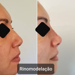 Rinomodelação x Rinoplastia

A rinomodelação é a correção temporária do formato nasal através da inf