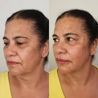 Bigode Chinês, nunca mais!

As rugas nasogenianas, popularmente conhecidas como “bigode chinês” são 