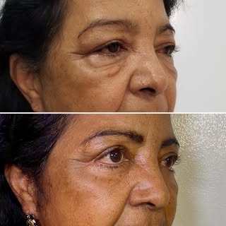 Blefaroplastia é o procedimento cirúrgico indicado para correção da flacidez palpebral, com a remoçã