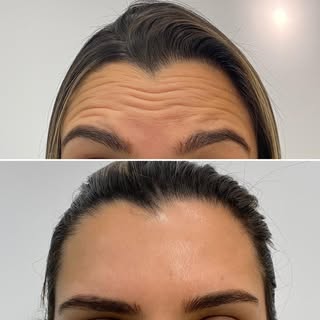 As rugas de expressão ou rugas dinâmicas são aquelas que aparecem pela ação dos músculos da mímica. 