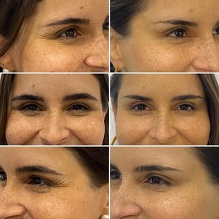 O “Botox®” (toxina botulínica) é indicado , dentre outras coisas, para tratamento de rugas de expres