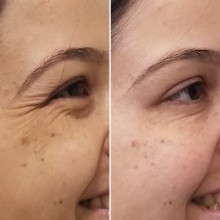 Rugas de expressão!!! Incomodado com as rugas de expressão? Então  não deixe de ler esse post!!! As 
