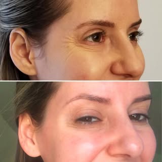 Aplicação do Botox® (toxina botulínica) para tratamento das rugas periorbitais, conhecidas como “pés