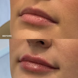 A little extra plump achieved with a half syringe of filler for that hydrated + natural look! 💋 Thi