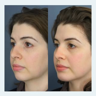 Small change, noticeable difference ✨

This patient is four months out from a chin and jawline augme