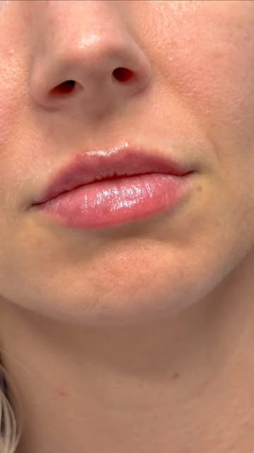 For this patient, a half a syringe is all it took for the perfect natural pout 💋 performed by @heat