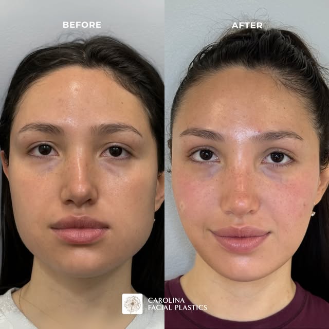 FACE SLIMMING TOX 💉 Also known as Masseter Botox! Did you know that this treatment has both cosmeti