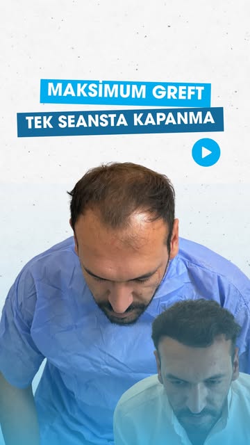 Saç ekimi sadece greftlerin yerleştirilmesinden ibaret değil.

Doğal bir görünüm; doğru planlama, de