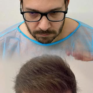🧑‍⚕️ Περιστατικό εκτεταμένης ανδρογενετικής αλωπεκίας (Norwood V).

🌱 Για την αποκατάσταση ολόκληρ
