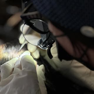 💉 La technique d’implantation Choï : un choix naturel et précis pour vos cheveux 

La méthode Choï,