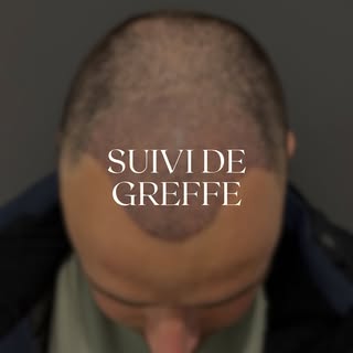 Une greffe capillaire est un processus en plusieurs étapes… et chaque détail compte pour un résultat