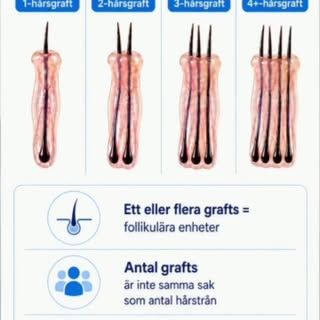 Vad är egentligen ett graft?

Dr Armin går igenom ett av de viktigaste begreppen inom hårtransplanta