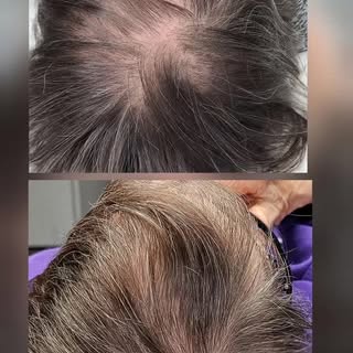 ProCell Scalp Treatment Results ✨
This before-and-after blows me away! After a series of ProCell sca