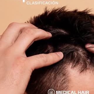 ¿Notas que tienes menos densidad en tu cabello? Este  reel te interesa.

¿Sabías que existe una esca