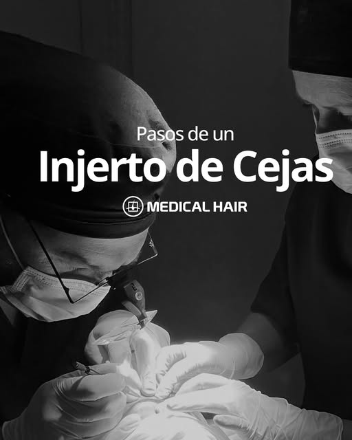 Las cejas naturales y pobladas están de moda, ¡y ahora es muy fácil conseguirlo! 

El injerto capila