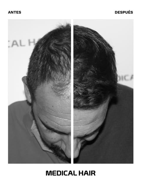 Te mostramos la evolución de un paciente tras su injerto capilar en Medical Hair, en el cual se ha t