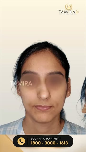 Thinking About Rhinoplasty? Your Nose Evaluation Explained | Front, Side & Base View

For Appointmen