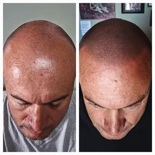 A totally natural and convincing hairline for my client making him look 10 years younger and getting