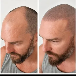 Scalp Micro-Pigmentation is a game-changer for anybody that has lost faith in all those so-called pr