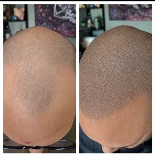 THE RESULTS ARE CLEAR !!
At Hilton Hair SMP Clinics you will get the totally guaranteed and permanen