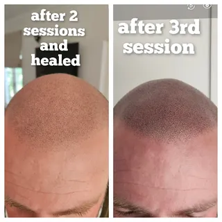 Hilton Hair SMP Clinics provides the permanent illusion of healthy, shortly shaved hair for anybody 