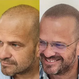 THE SMILE SAYS IT ALL !

Hair loss can gradually affect more than just  your appearance. 
It can aff