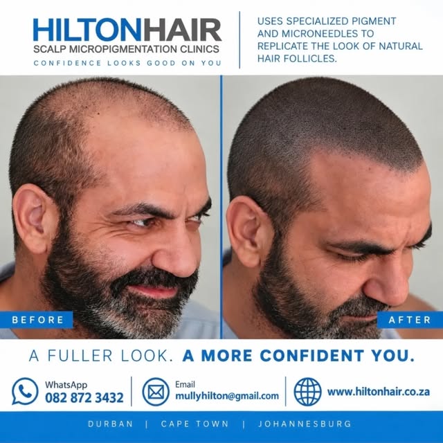 SMP is the EASIEST and most EFFECTIVE way to SOLVE BALDING, create FULLNESS with thinning hair and r