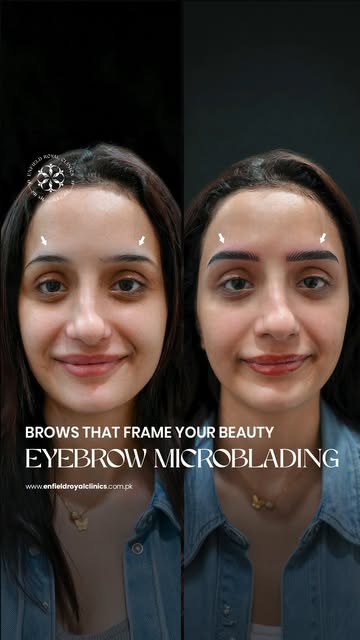 Real transformation, real confidence! ✨
Meerab got her Eyebrow Microblading done at Enfield Royal Cl