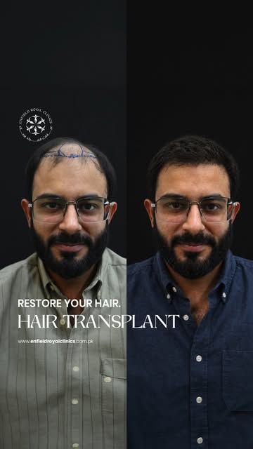 Ready to restore your natural hairline and confidence? ✨
DHI Hair Transplant at Enfield Royal Clinic