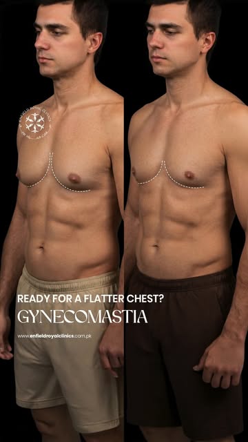 Struggling with enlarged male chest tissue? 💪
Gynecomastia treatment at Enfield Royal Clinic helps 