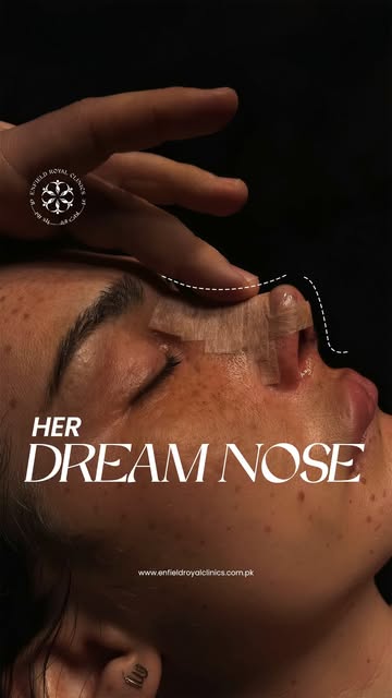 Dreaming of a nose that perfectly complements your face? ✨
Rhinoplasty by Dr. Naveed Azhar at Enfiel