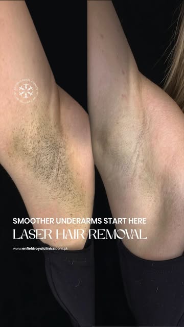 Tired of constant shaving and waxing? ✨
Laser Hair Removal at Enfield Royal Clinic gives you smooth,