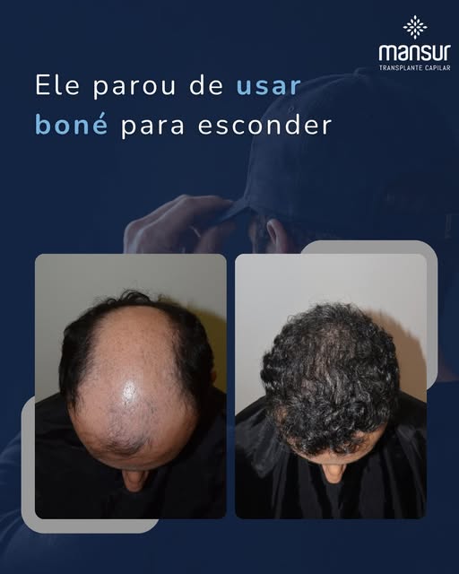 O que pode mudar depois do transplante capilar?

O resultado aparece no cabelo, mas também pode ser 