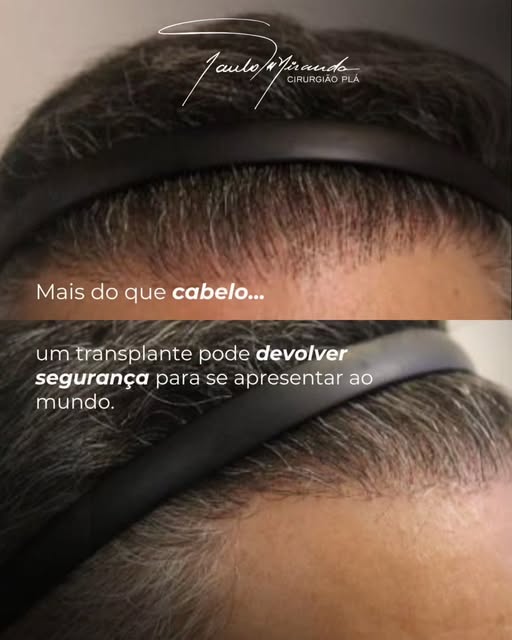 Um transplante capilar vai muito além da recuperação dos fios.

Para muitos pacientes, o cabelo repr